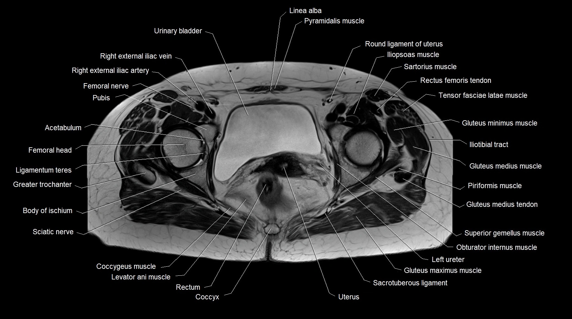 MRI 3T pelvis axial cross section anatomy image 22.webp